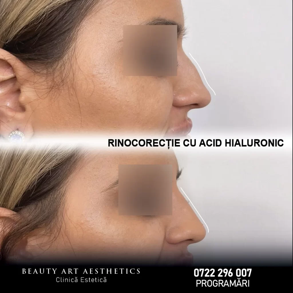 Rinocorectie - Beauty Art Aesthetics
